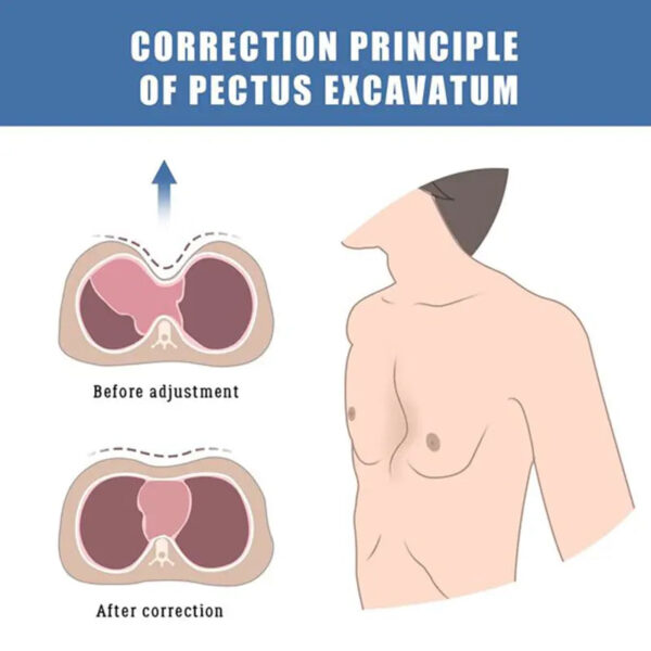 Pectus Excavatum Brace Pectus Excavatum Vacuum Bell Pectus Excavatum Orthosis Sternum Brace Chest Brace for Pectus Excavatum for - Image 4
