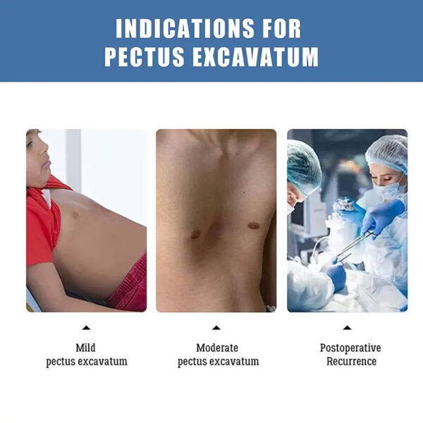 Pectus Excavatum Brace Pectus Excavatum Vacuum Bell Pectus Excavatum Orthosis Sternum Brace Chest Brace for Pectus Excavatum for - Image 6